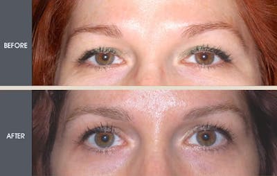 Brow Lift Gallery Before & After Gallery - Patient 2206329 - Image 1