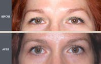 Brow Lift Gallery Before & After Gallery - Patient 2206329 - Image 1