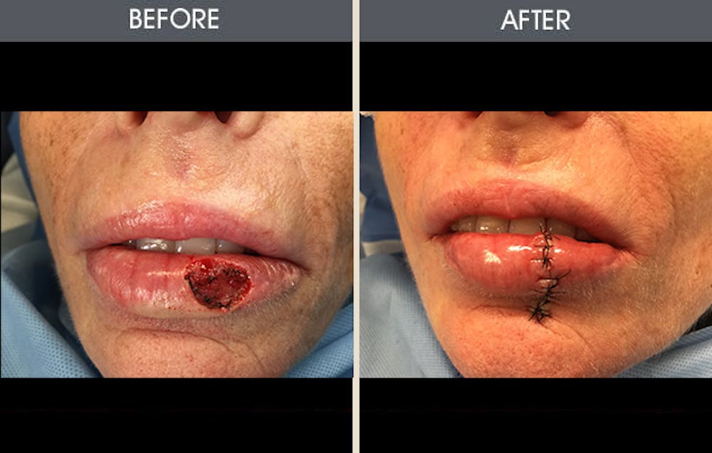 Skin Cancer Reconstruction Before & After Gallery - Patient 367156 - Image 1
