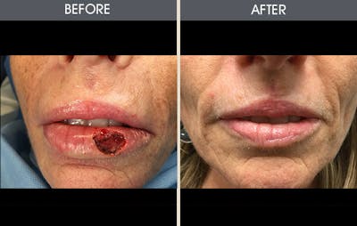 Skin Cancer Reconstruction Before & After Gallery - Patient 367156 - Image 2