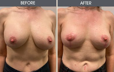 Breast Lift Gallery Before & After Gallery - Patient 939087 - Image 1