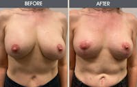 Breast Lift Before & After Gallery - Patient 939087 - Image 1