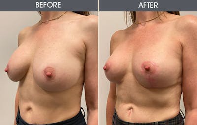 Breast Lift Gallery Before & After Gallery - Patient 939087 - Image 2