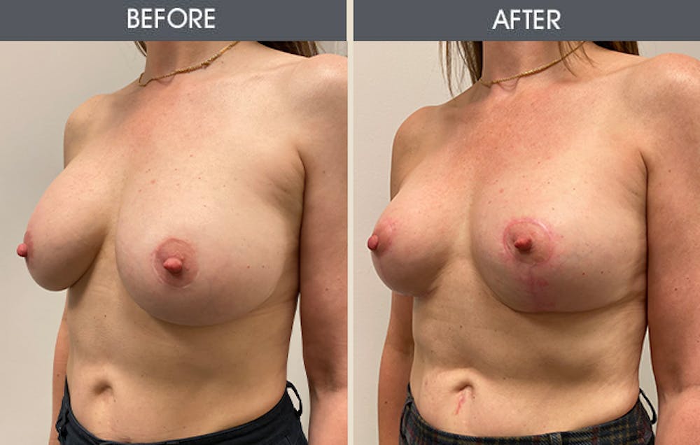 Breast Lift Gallery Before & After Gallery - Patient 939087 - Image 2