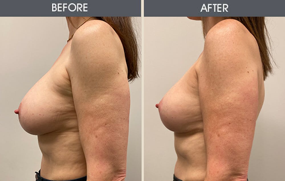 Breast Lift Gallery Before & After Gallery - Patient 939087 - Image 3