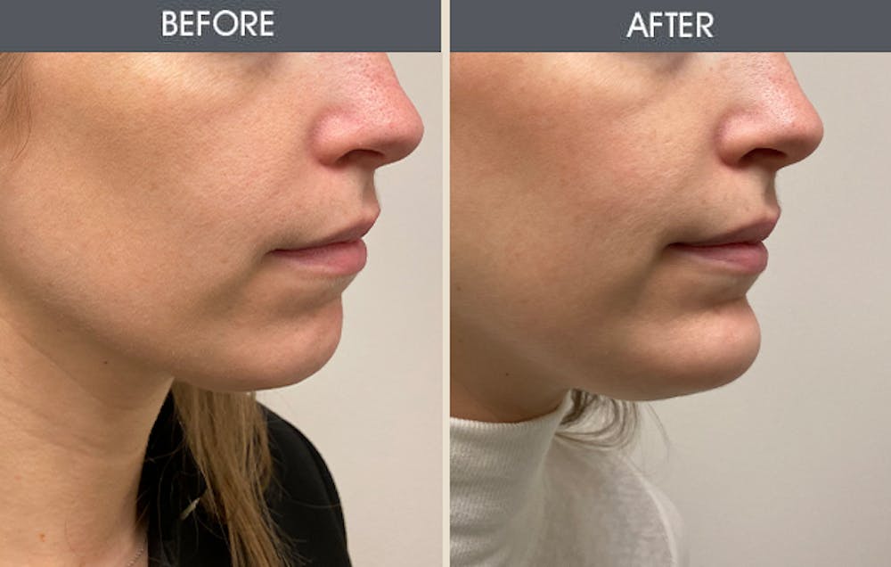Chin Implants Gallery Before & After Gallery - Patient 361351 - Image 2