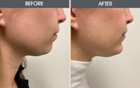 Chin Implants Before & After Gallery - Patient 361351 - Image 1