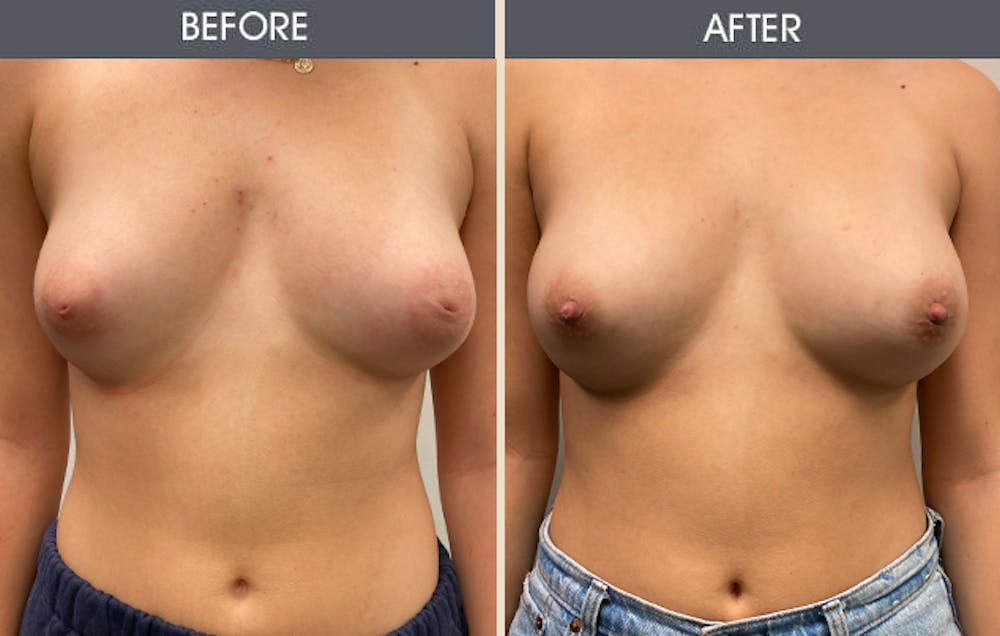 Inverted Nipple Repair Gallery Before & After Gallery - Patient 111301 - Image 1