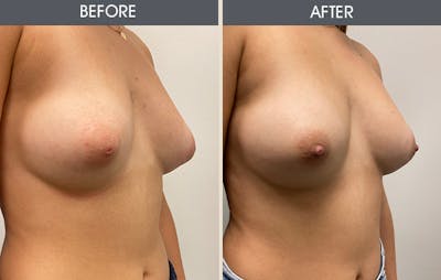 Inverted Nipple Repair Gallery Before & After Gallery - Patient 111301 - Image 2