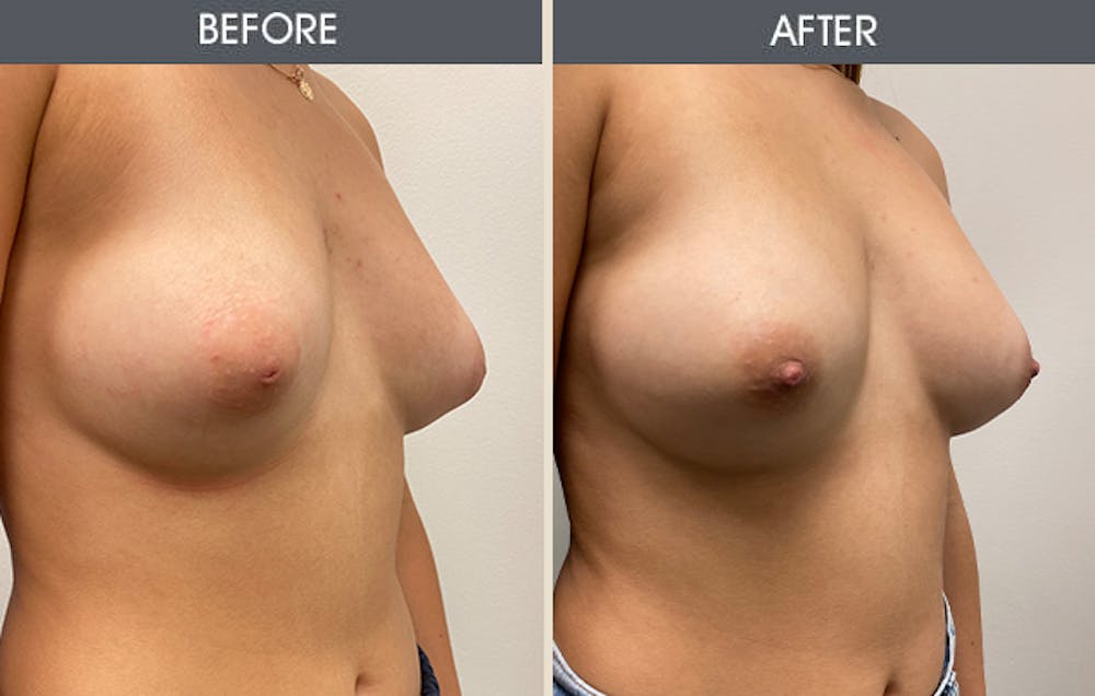 Inverted Nipple Repair Gallery Before & After Gallery - Patient 111301 - Image 2