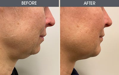 Submental Liposuction Gallery Before & After Gallery - Patient 289253 - Image 1