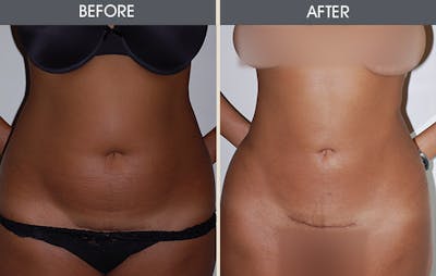 Liposuction Before & After Gallery