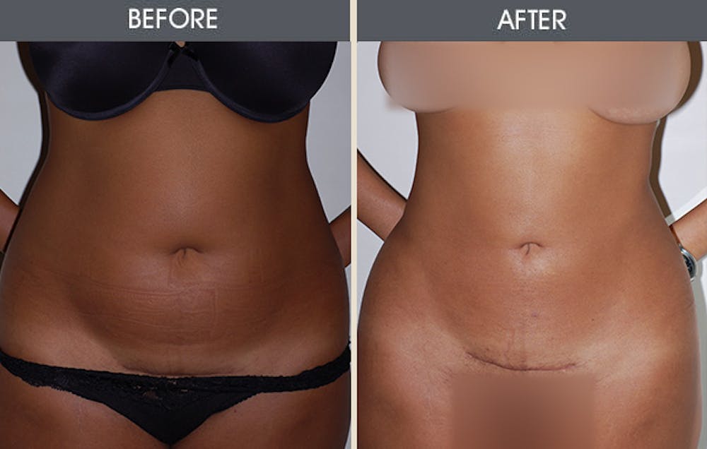 Liposuction Gallery Before & After Gallery - Patient 405194 - Image 1