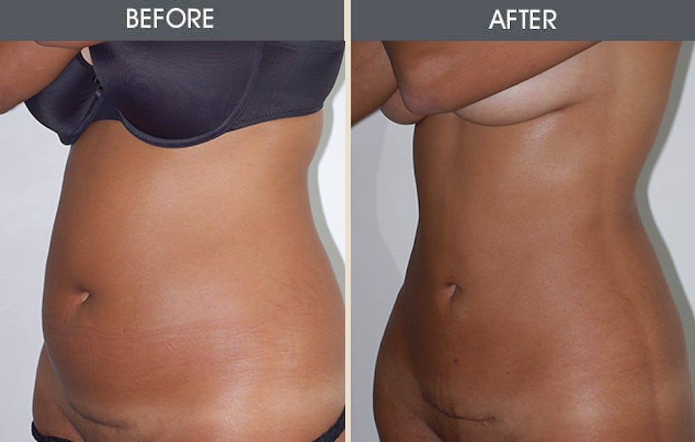 Liposuction Gallery Before & After Gallery - Patient 405194 - Image 2