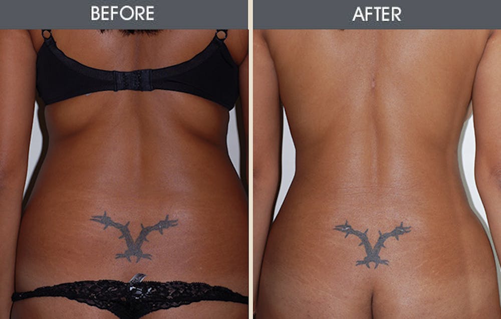 Liposuction Gallery Before & After Gallery - Patient 405194 - Image 3