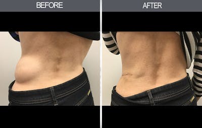 Lipoma Removal Gallery Before & After Gallery - Patient 4448468 - Image 2