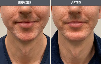 Chin Implants Gallery Before & After Gallery - Patient 169274 - Image 1