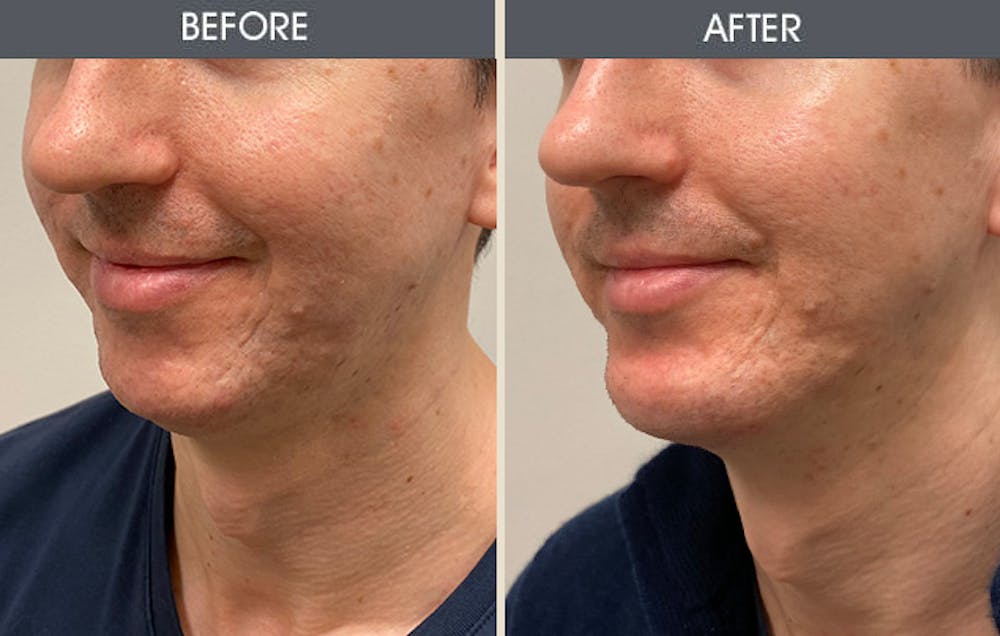 Chin Implants Gallery Before & After Gallery - Patient 169274 - Image 3