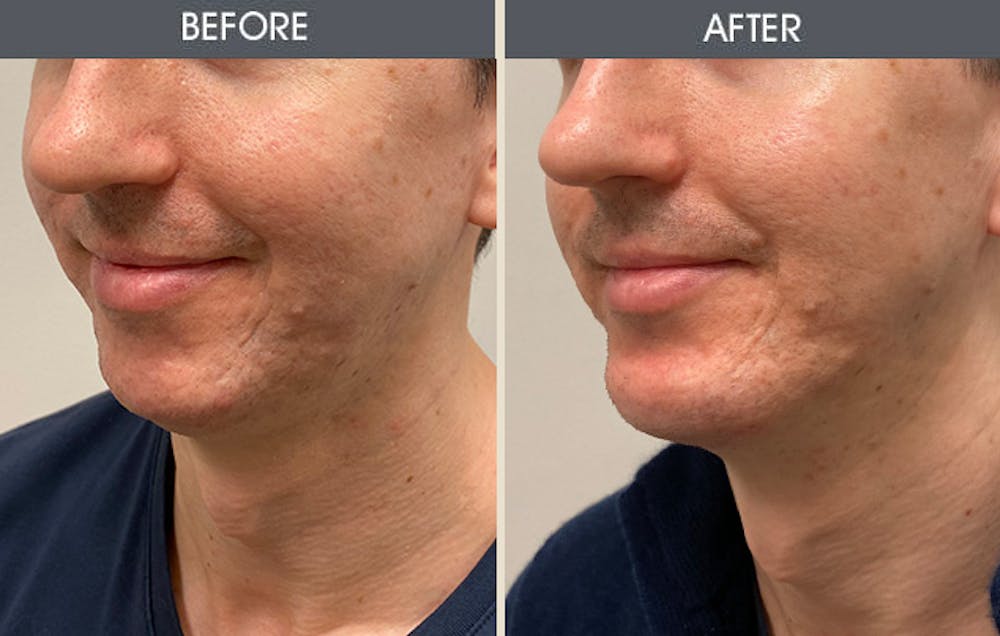 Chin Implants Gallery Before & After Gallery - Patient 169274 - Image 2