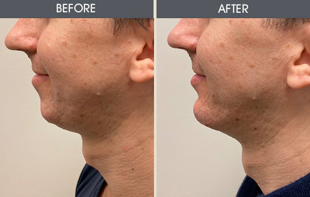 Chin Implants Gallery Before & After Gallery - Patient 169274 - Image 1