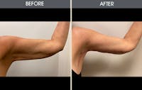 Arm Lift (Brachioplasty) Gallery Before & After Gallery - Patient 184477 - Image 1