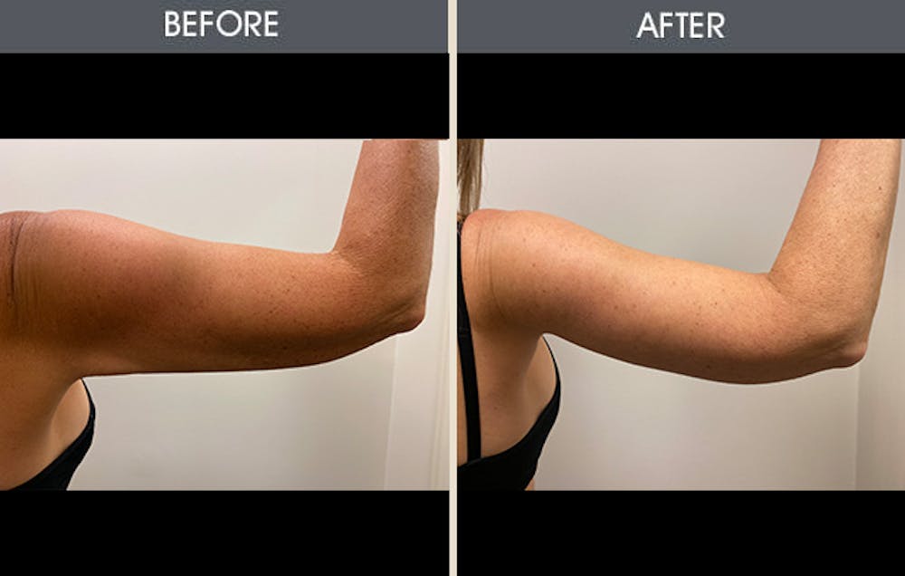 Arm Lift (Brachioplasty) Gallery Before & After Gallery - Patient 184477 - Image 2