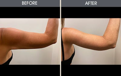Arm Lift (Brachioplasty) Gallery Before & After Gallery - Patient 184477 - Image 2