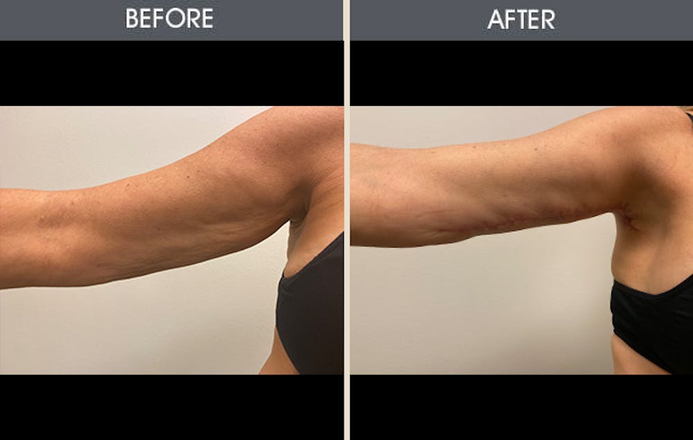 Arm Lift (Brachioplasty) Gallery Before & After Gallery - Patient 184477 - Image 3