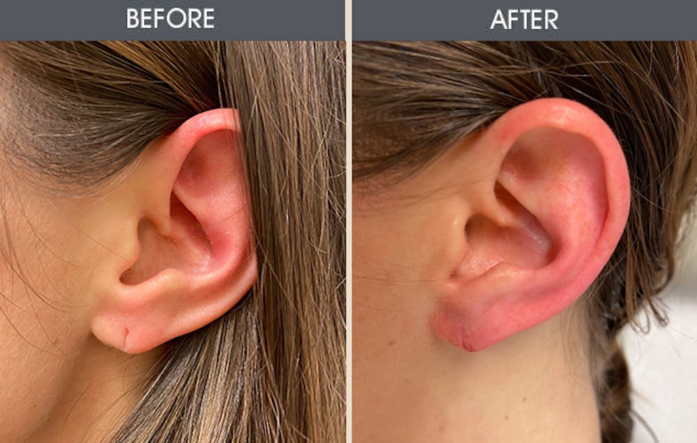 Earlobe Repair Gallery Before & After Gallery - Patient 403204 - Image 1