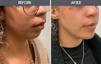 Chin Implants Gallery Before & After Gallery - Patient 515276 - Image 1