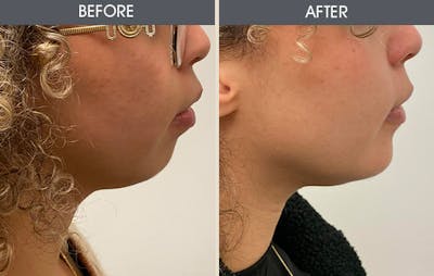 Chin Implants Gallery Before & After Gallery - Patient 515276 - Image 2