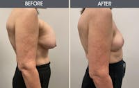 Breast Implant Removal Gallery Before & After Gallery - Patient 148128632 - Image 1