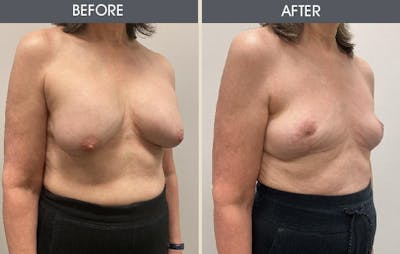 Breast Implant Removal Gallery Before & After Gallery - Patient 148128632 - Image 2