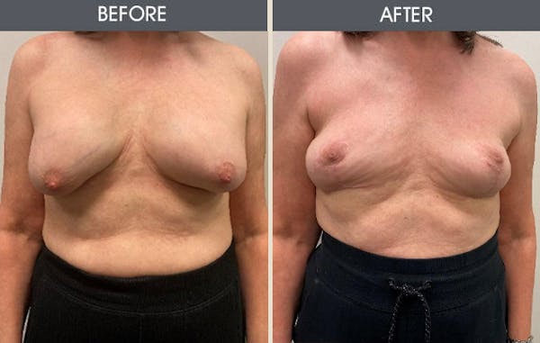 Breast Implant Removal Gallery Before & After Gallery - Patient 148128632 - Image 3