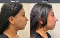 Dermal Fillers Gallery Before & After Gallery - Patient 456943 - Image 1