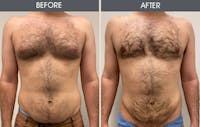 Male Breast Reduction (Gynecomastia) Gallery Before & After Gallery - Patient 307507 - Image 1