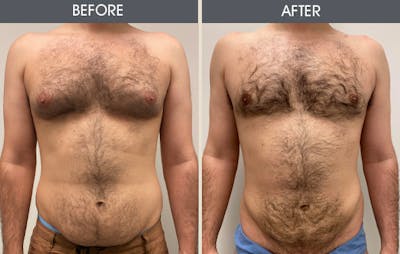 Male Breast Reduction (Gynecomastia) Gallery Before & After Gallery - Patient 307507 - Image 1