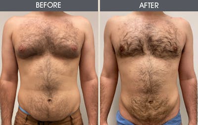 Liposuction Gallery Before & After Gallery - Patient 197027 - Image 1