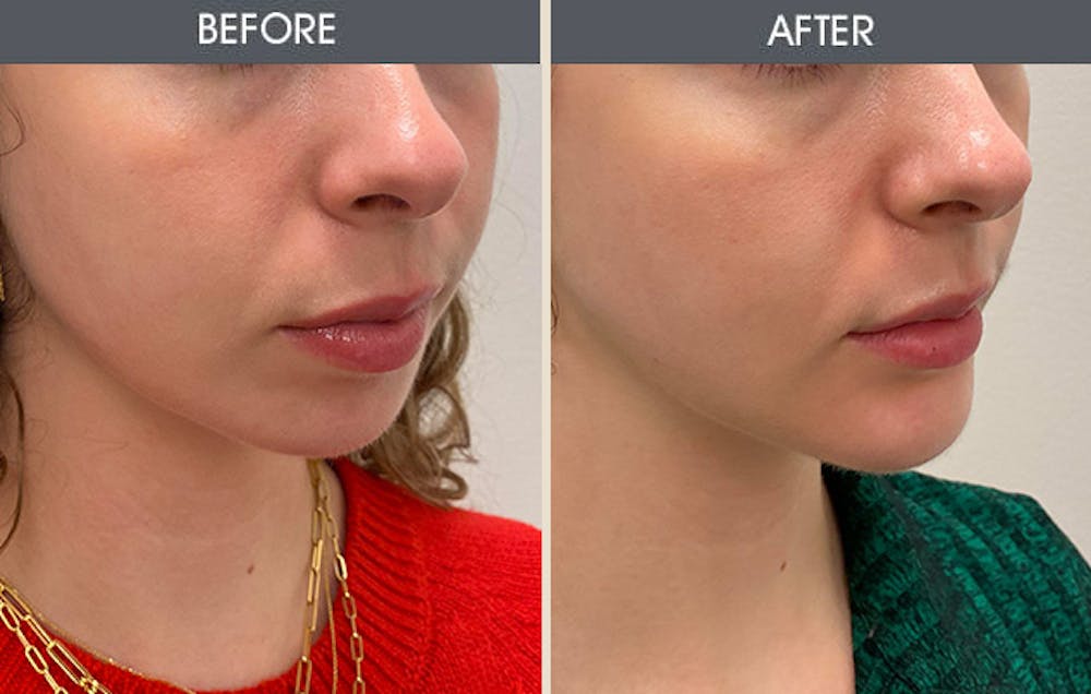 Chin Implants Gallery Before & After Gallery - Patient 204223 - Image 3
