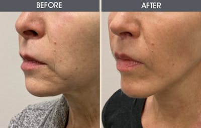 Lip Lift Gallery Before & After Gallery - Patient 392676 - Image 2