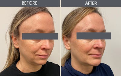 Submental Liposuction Gallery Before & After Gallery - Patient 311888 - Image 2