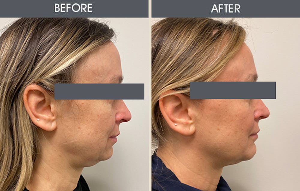 Submental Liposuction Gallery Before & After Gallery - Patient 311888 - Image 3