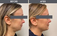 Chin Implants Gallery Before & After Gallery - Patient 317481 - Image 1