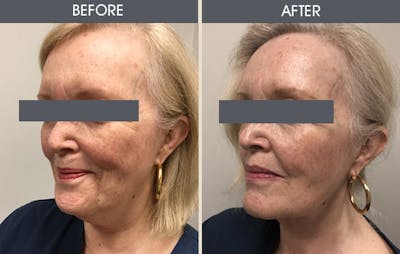 Submental Liposuction Gallery Before & After Gallery - Patient 324291 - Image 2