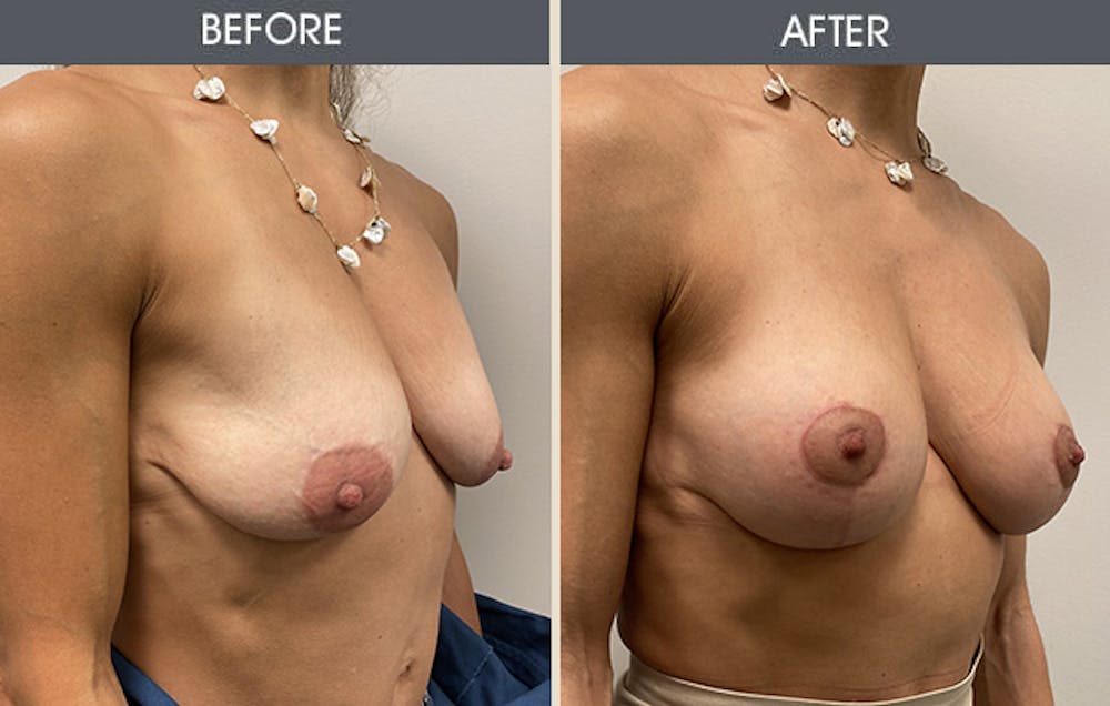 Breast Lift Gallery Before & After Gallery - Patient 276386 - Image 2
