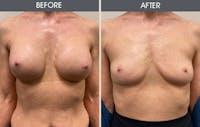 Breast Implant Removal Gallery Before & After Gallery - Patient 214500 - Image 1