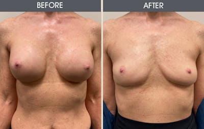 Breast Implant Removal Gallery Before & After Gallery - Patient 214500 - Image 1