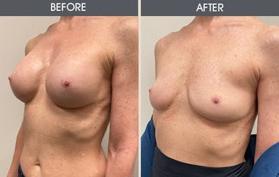 Breast Implant Removal Gallery Before & After Gallery - Patient 214500 - Image 2