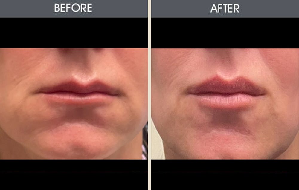 Lip Fillers Gallery Before & After Gallery - Patient 325187 - Image 1