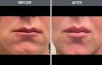 Lip Fillers Gallery Before & After Gallery - Patient 325187 - Image 1